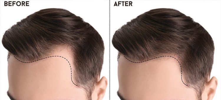 Elevating Confidence: Exploring the Premier Hair Transplant Clinics in Pakistan