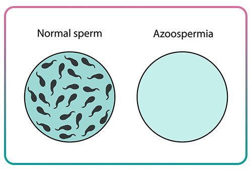 Azoospermia: A Detailed Overview