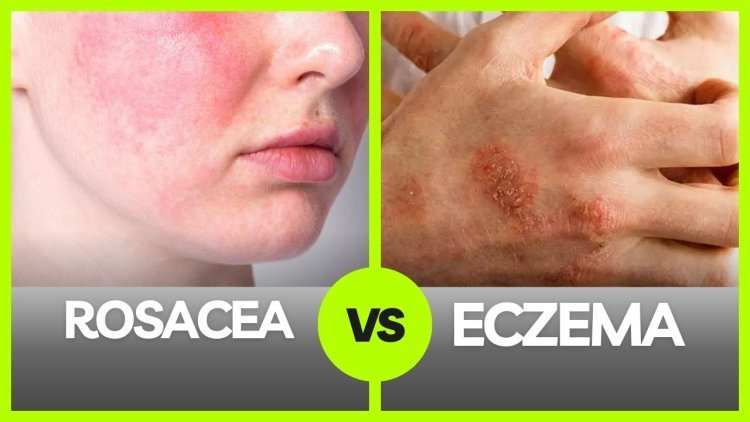 Rosacea vs Eczema: Key Differences and How to Tell Them Apart