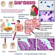 The Best Foods to Eat When You Have Giardiasis