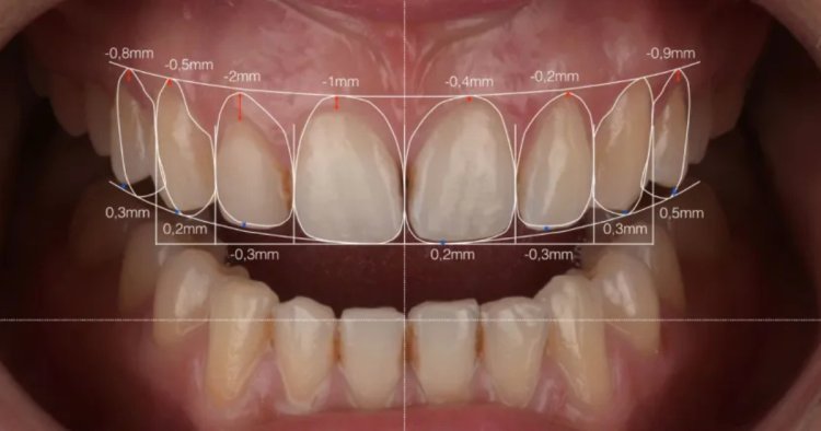 How to Choose the Right Dental Veneers for You