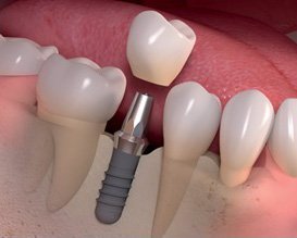 Discover the Best Dental Implants in Ahmedabad at Bright Smile Dental Care