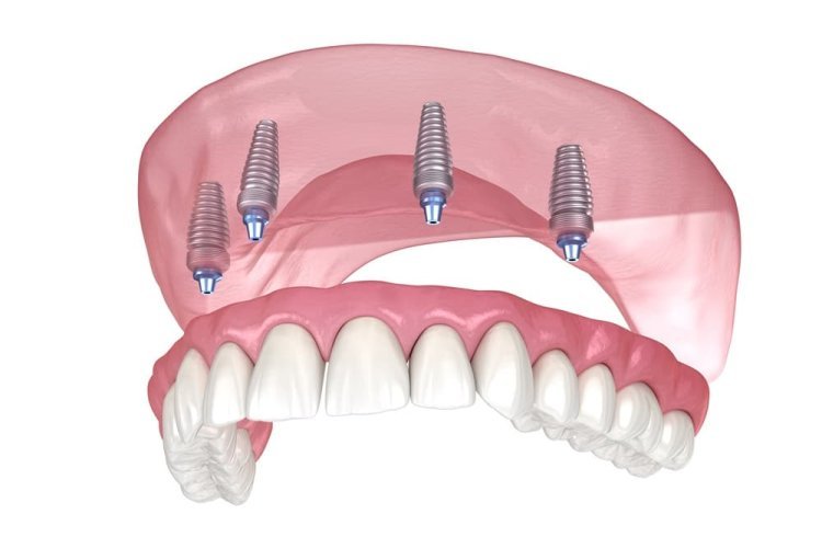 Cost vs. Value| Are All-on-4 Implants Worth the Investment?