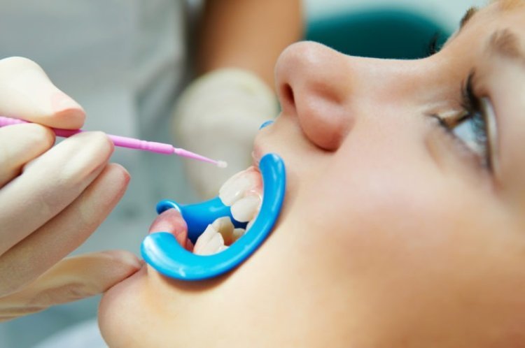 Dental Sealants - An Important Preventive Measure For Kids