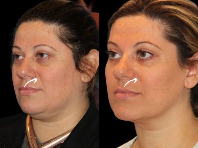 Best Aesthetic Clinic in Dubai How Sculptra Stimulates Collagen Production