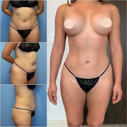 Body Contouring in Dubai: The Best Procedures for a More Sculpted Body