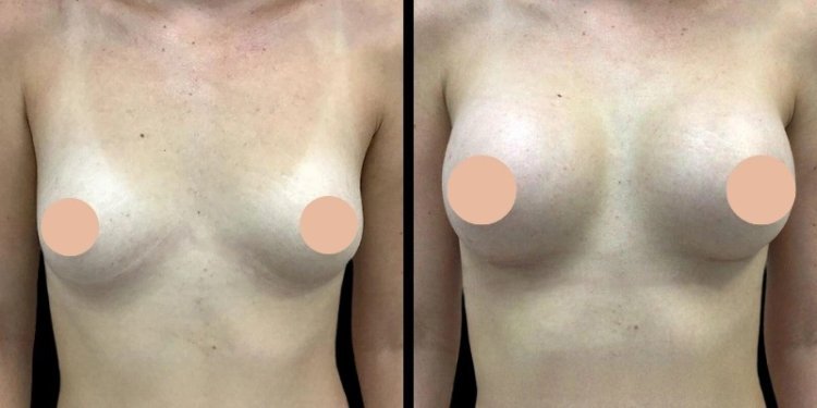 The Best Breast Augmentation Surgeons in Dubai: Safe Procedures for Stunning Results