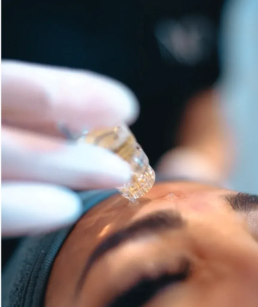 Can an AquaGold Facial Minimize Large Pores Effectively?