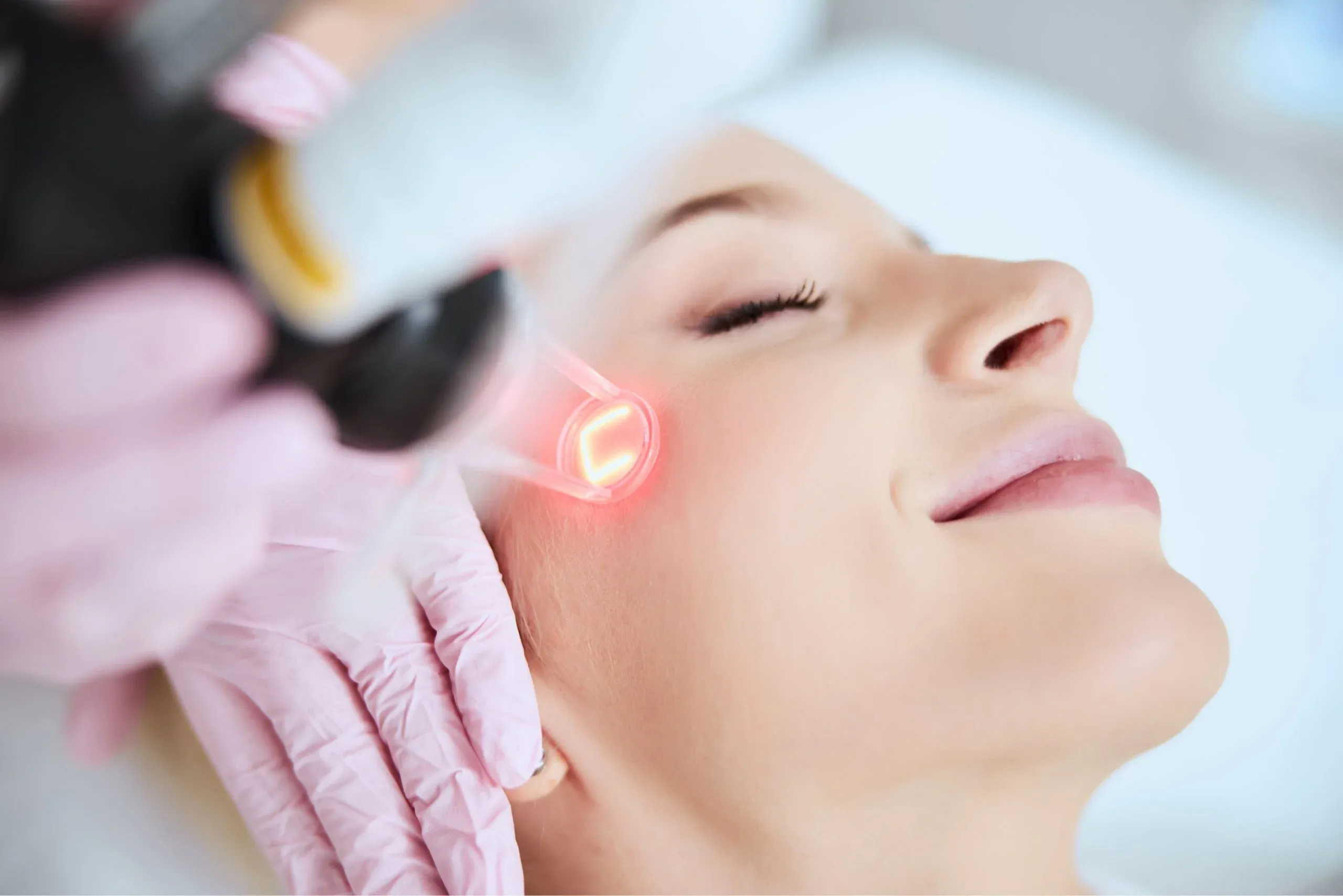 Softening Deep Acne Scars via Pico Laser Treatment