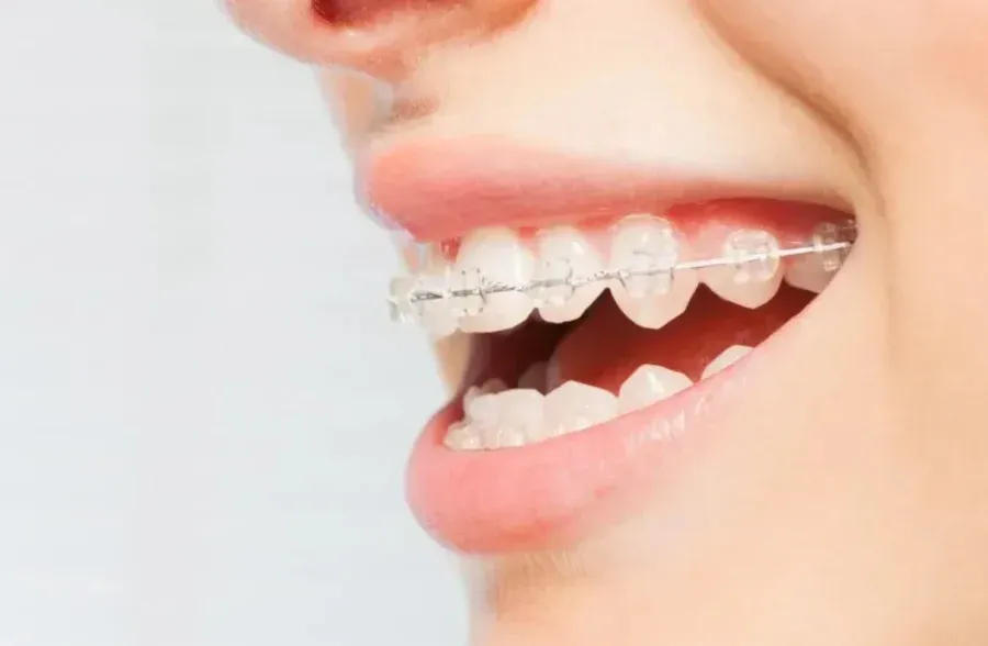 A Complete Guide to Clear Aligners: Treatment Options, Benefits & Aligners Price